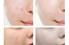 Acne Treatment Face Serum Mask