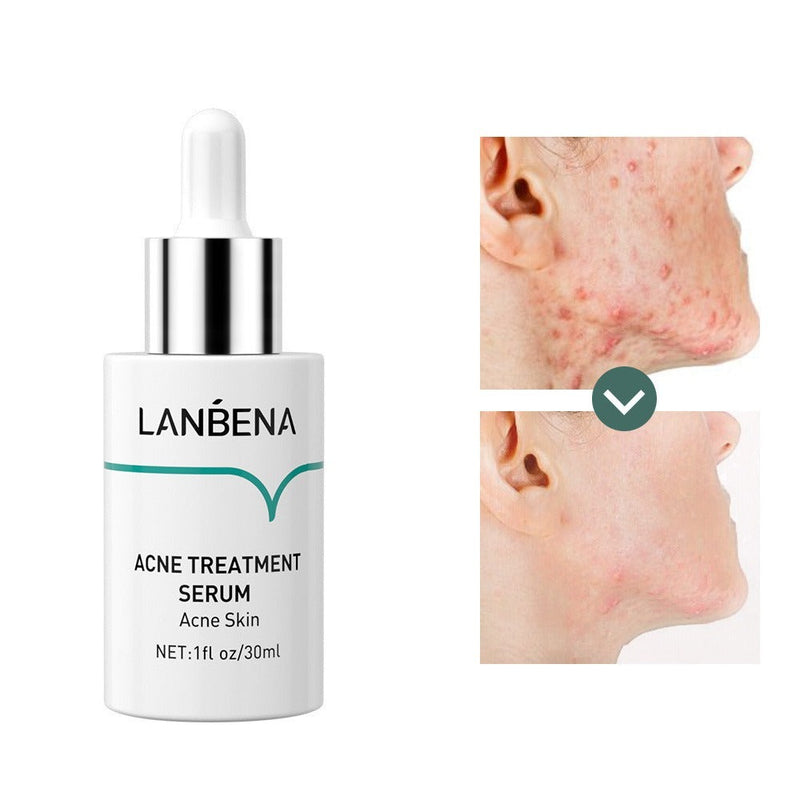 ACNE TREATMENT SERUM