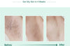 Laser IPL Hair Removal